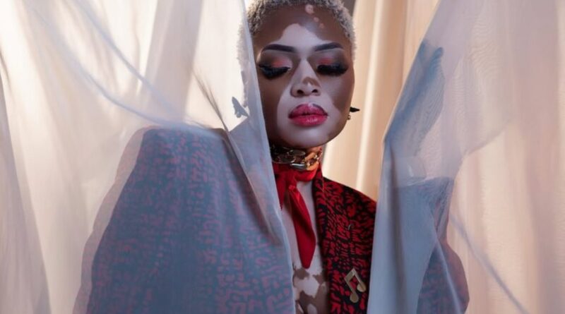Yolanda Shares A Powerful Message to Mark World Vitiligo Day